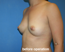 plastic-surgery-breast-augmentation